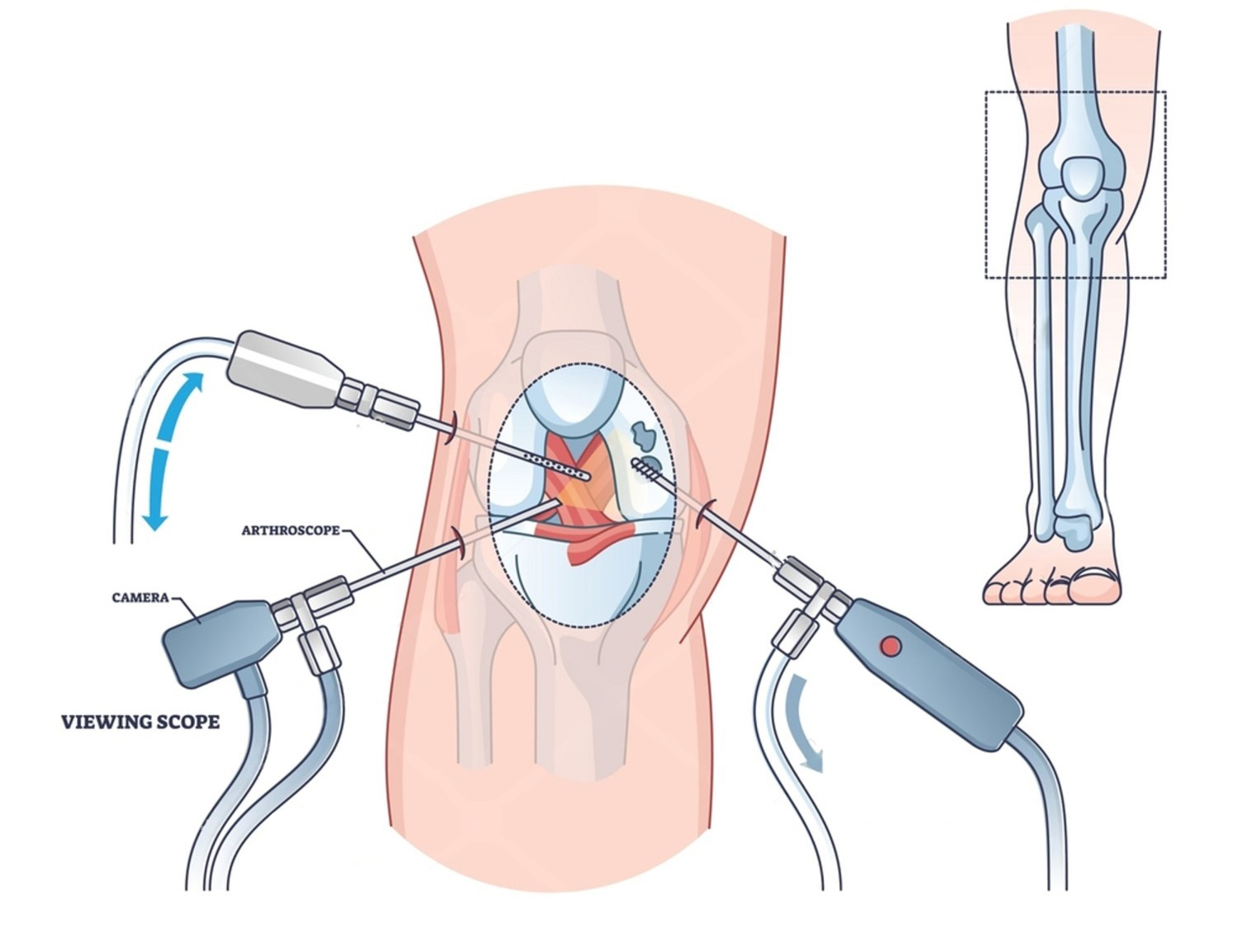Technique de mosaïcplastie