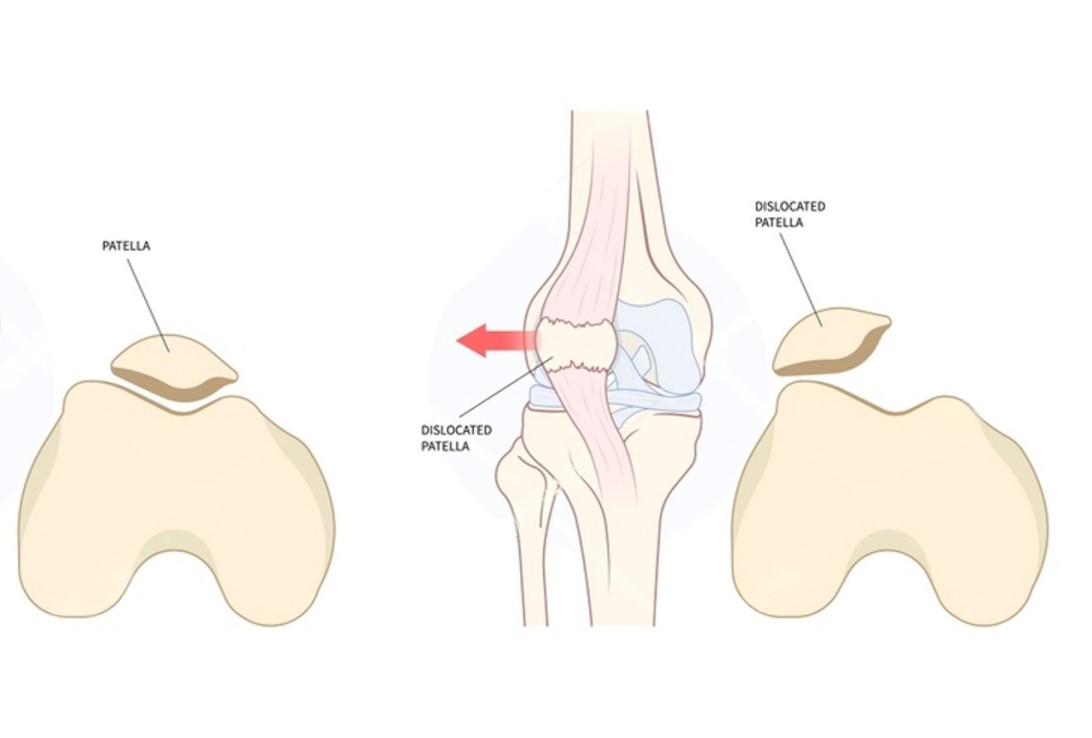 Stabilisation patellaire - Anatomie